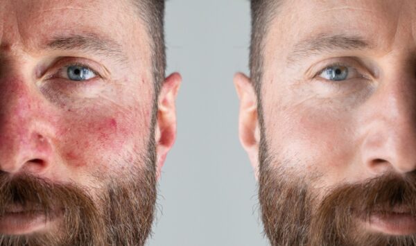 Trądzik różowaty – dlaczego skóra reaguje rumieniem i jak ją właściwie wspierać?
